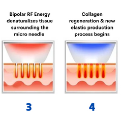 Beauty Disruptor™ RF Microneedling Machine 3 in 1