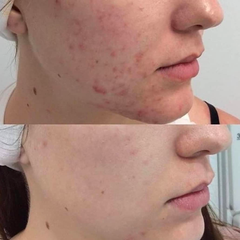 Metamorph8.5™ Golden Youth RF Microneedling Machine