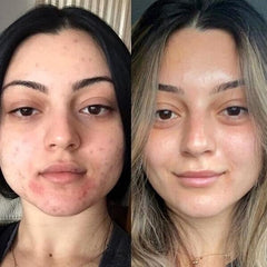 Metamorph8.5™ Golden Youth RF Microneedling Machine