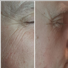 Pro-Secret™ Icy Gold RF Microneedling Machine