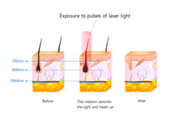ViQure EpiPro 808nm Diode Laser Hair Removal Device
